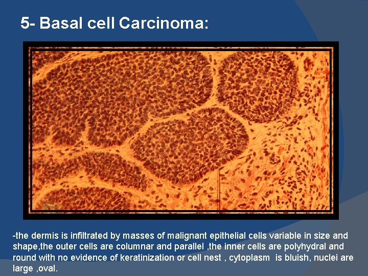 5 - Basal cell Carcinoma: -the dermis is infiltrated by masses of malignant epithelial