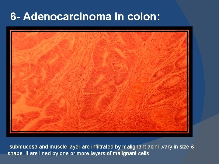 6 - Adenocarcinoma in colon: -submucosa and muscle layer are infiltrated by malignant acini