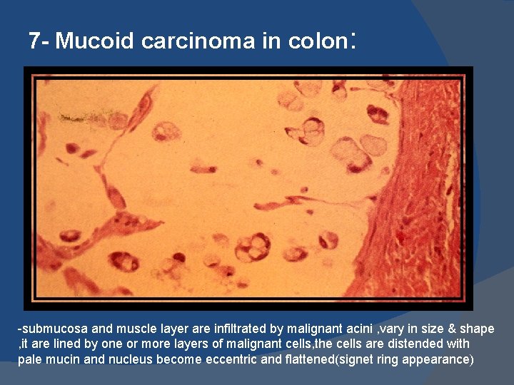 7 - Mucoid carcinoma in colon: -submucosa and muscle layer are infiltrated by malignant