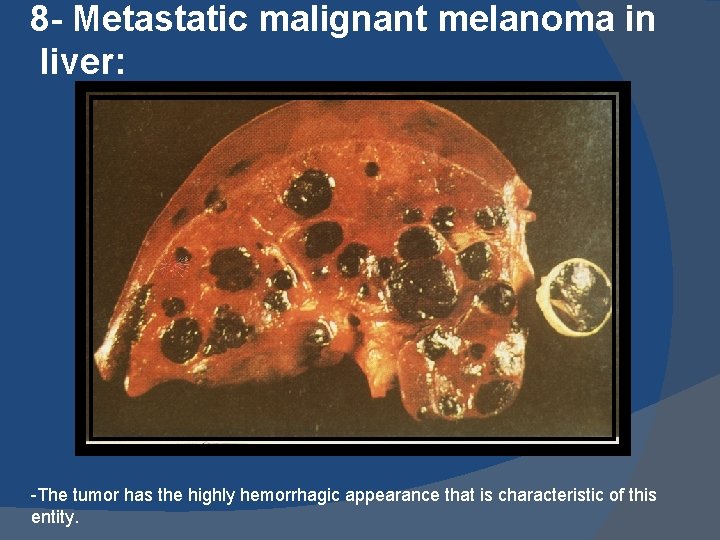 8 - Metastatic malignant melanoma in liver: -The tumor has the highly hemorrhagic appearance