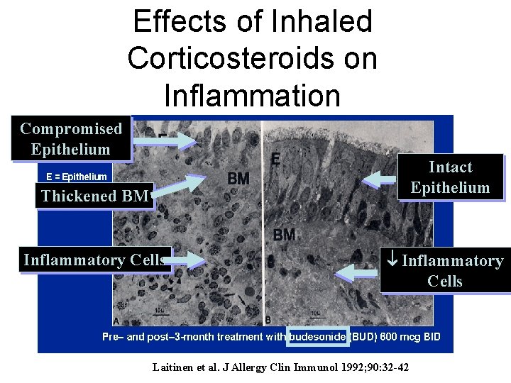 Effects of Inhaled Corticosteroids on Inflammation Compromised Epithelium Intact Epithelium Thickened BM Inflammatory Cells