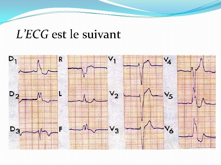 L’ECG est le suivant 