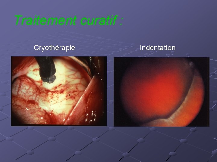 Traitement curatif : Cryothérapie Indentation 