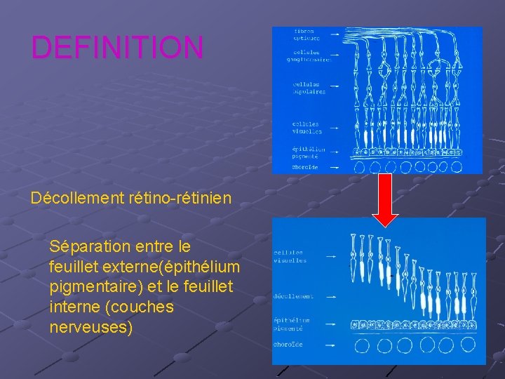 DEFINITION Décollement rétino-rétinien Séparation entre le feuillet externe(épithélium pigmentaire) et le feuillet interne (couches