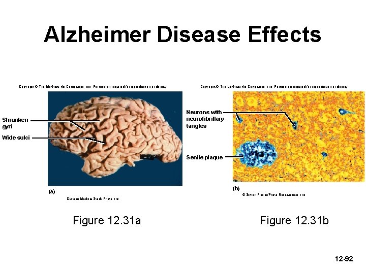 Alzheimer Disease Effects Copyright © The Mc. Graw-Hill Companies, Inc. Permission required for reproduction