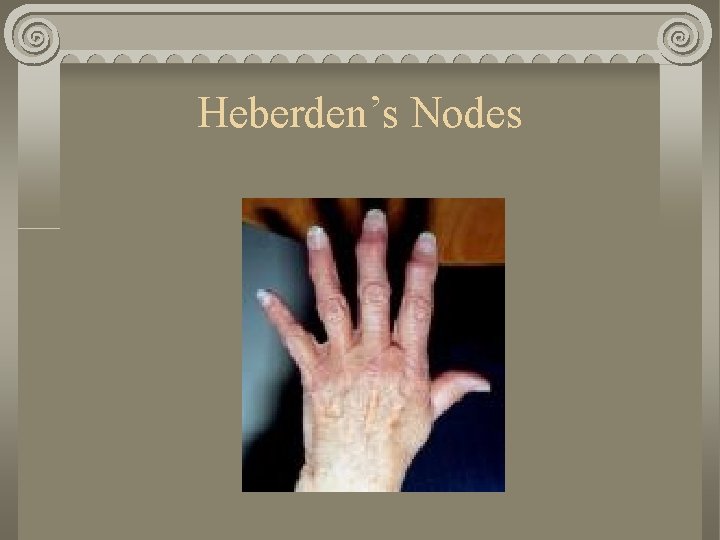 Heberden’s Nodes 