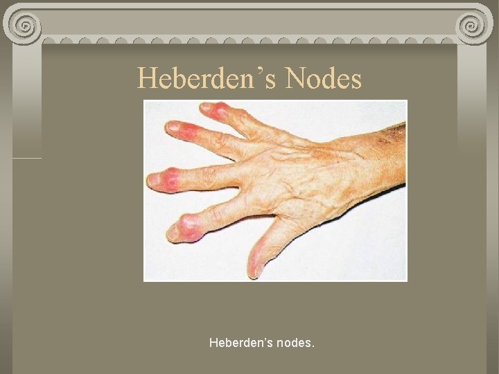 Heberden’s Nodes Heberden’s nodes. 