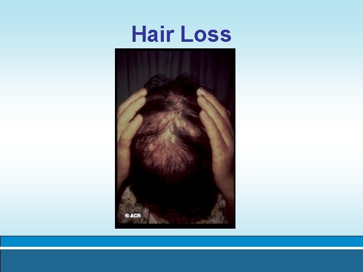 Hair Loss 