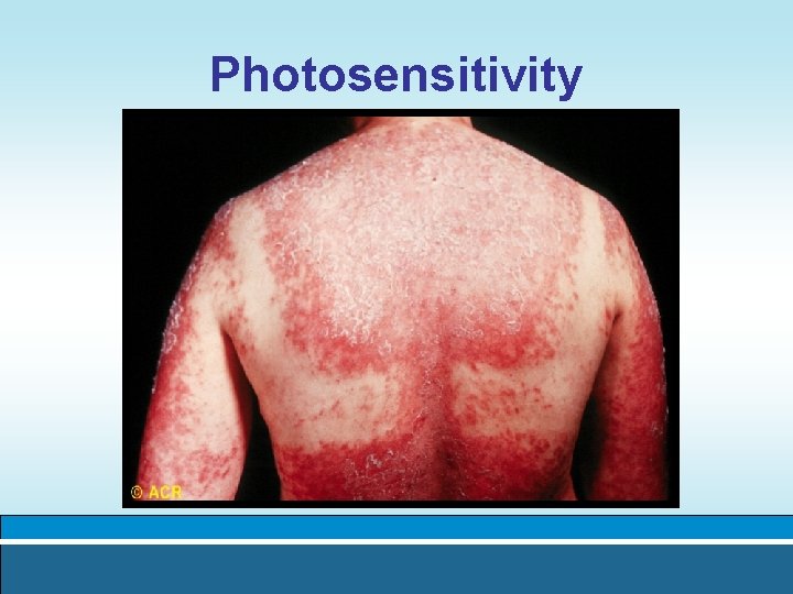 Photosensitivity 