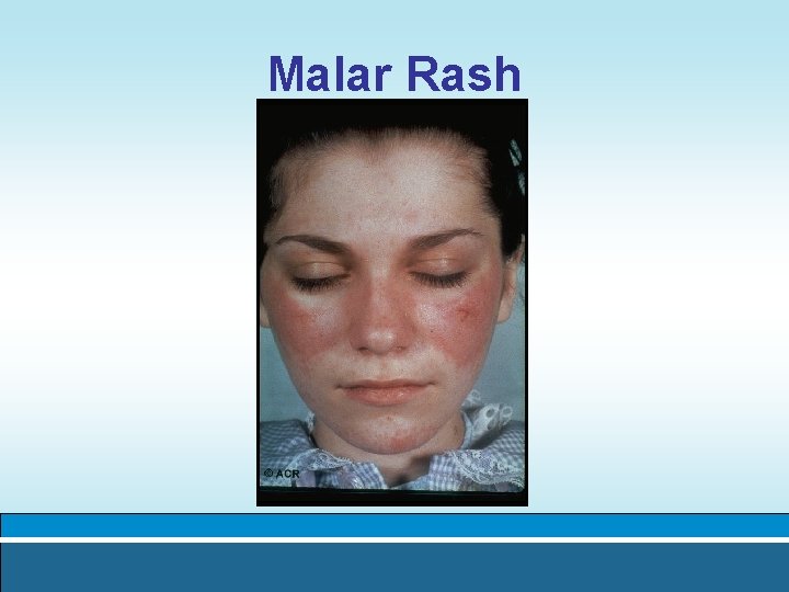 Malar Rash 