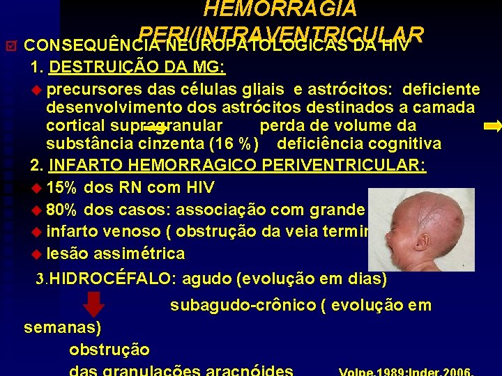 HEMORRAGIA PERI/INTRAVENTRICULAR þ CONSEQUÊNCIA NEUROPATOLOGICAS DA HIV 1. DESTRUIÇÃO DA MG: u precursores das