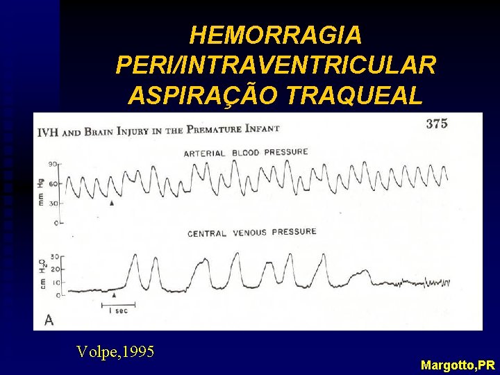 HEMORRAGIA PERI/INTRAVENTRICULAR ASPIRAÇÃO TRAQUEAL Volpe, 1995 Margotto, PR 