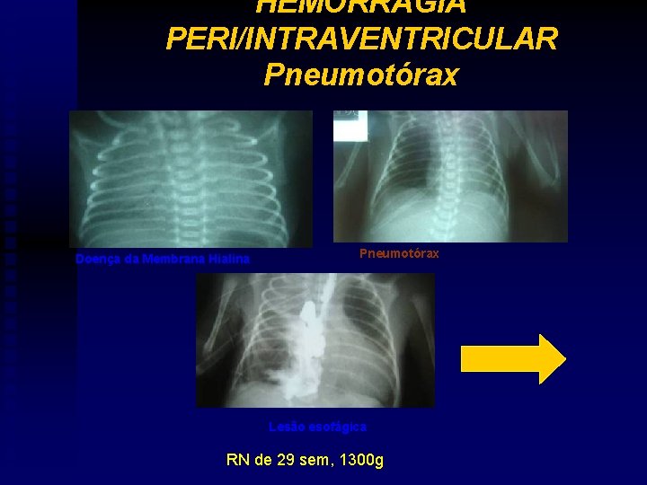 HEMORRAGIA PERI/INTRAVENTRICULAR Pneumotórax Doença da Membrana Hialina Pneumotórax Lesão esofágica RN de 29 sem,
