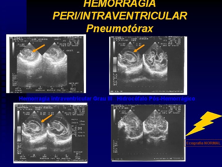 HEMORRAGIA PERI/INTRAVENTRICULAR Pneumotórax Hemorragia intraventricular Grau III Hidrocéfalo Pós-Hemorrágico Ecografia NORMAL 