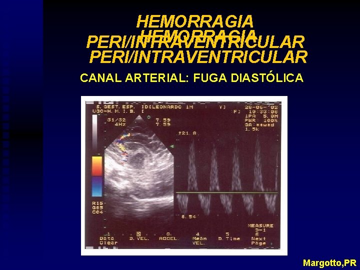 HEMORRAGIA PERI/INTRAVENTRICULAR CANAL ARTERIAL: FUGA DIASTÓLICA Margotto, PR 