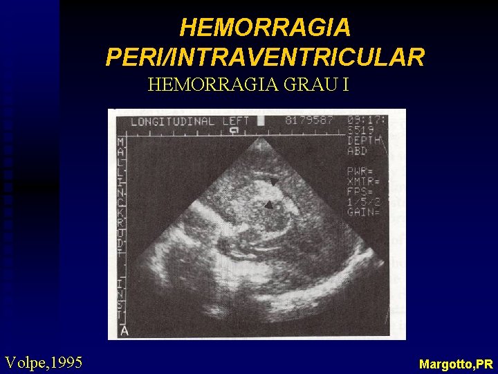 HEMORRAGIA PERI/INTRAVENTRICULAR HEMORRAGIA GRAU I Volpe, 1995 Margotto, PR 