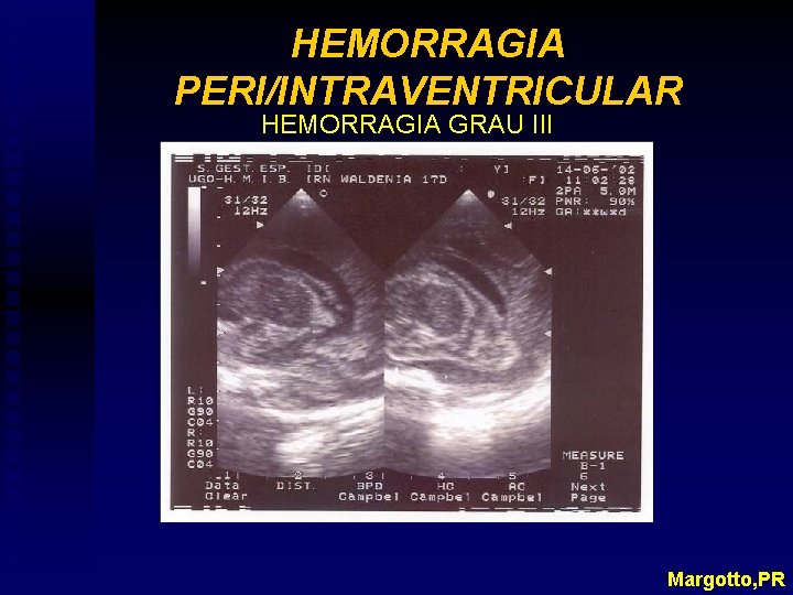 HEMORRAGIA PERI/INTRAVENTRICULAR HEMORRAGIA GRAU III Margotto, PR 