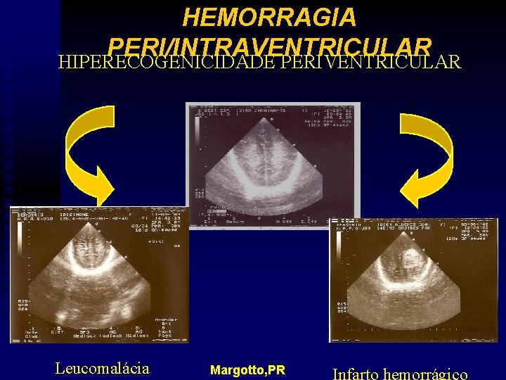 HEMORRAGIA PERI/INTRAVENTRICULAR HIPERECOGENICIDADE PERIVENTRICULAR Leucomalácia Margotto, PR 