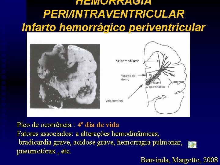 HEMORRAGIA PERI/INTRAVENTRICULAR Infarto hemorrágico periventricular Pico de ocorrência : 4º dia de vida Fatores