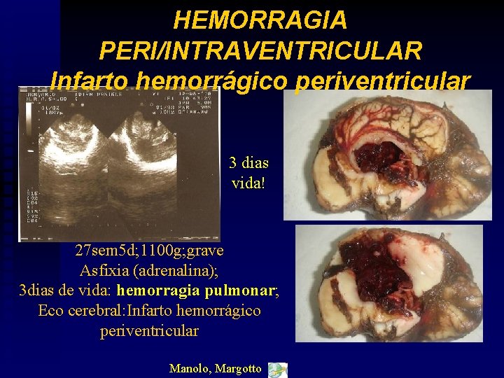 HEMORRAGIA PERI/INTRAVENTRICULAR Infarto hemorrágico periventricular 3 dias vida! 27 sem 5 d; 1100 g;