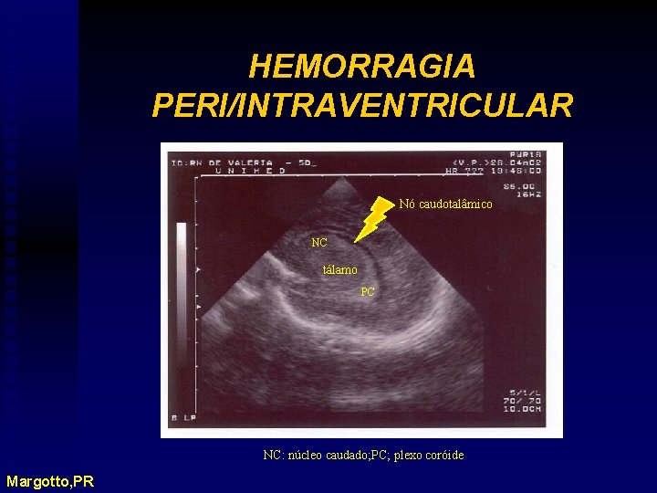 HEMORRAGIA PERI/INTRAVENTRICULAR Nó caudotalâmico NC tálamo PC NC: núcleo caudado; PC; plexo coróide Margotto,