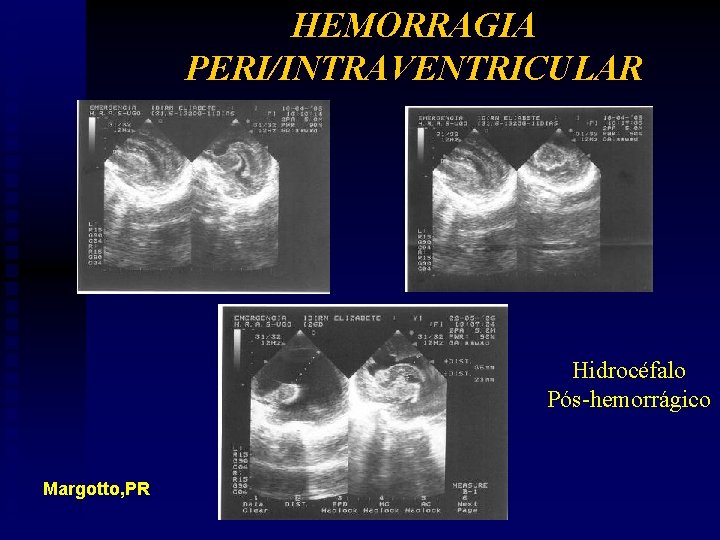 HEMORRAGIA PERI/INTRAVENTRICULAR Hidrocéfalo Pós-hemorrágico Margotto, PR 