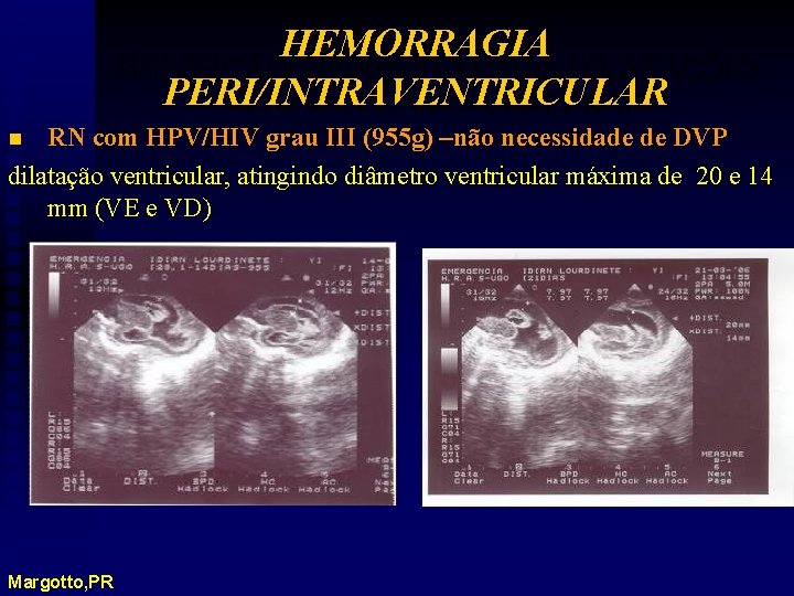 HEMORRAGIA SIGNIFICADO PERINATAL DAS DILATAÇÕES PERI/INTRAVENTRICULARES CEREBRAIS RN com HPV/HIV grau III (955 g)