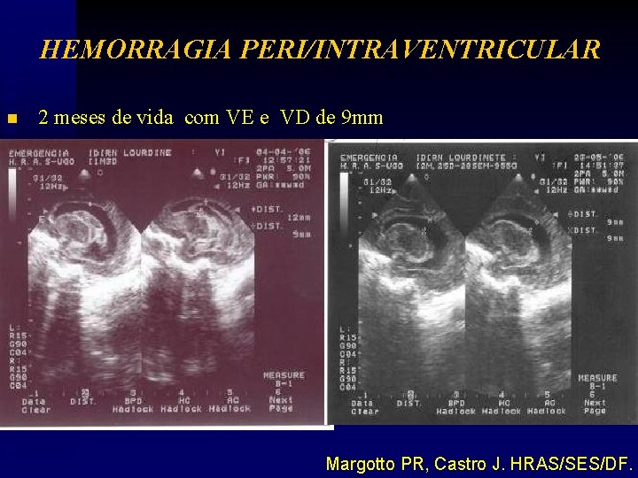 HEMORRAGIA PERI/INTRAVENTRICULAR n 2 meses de vida com VE e VD de 9 mm