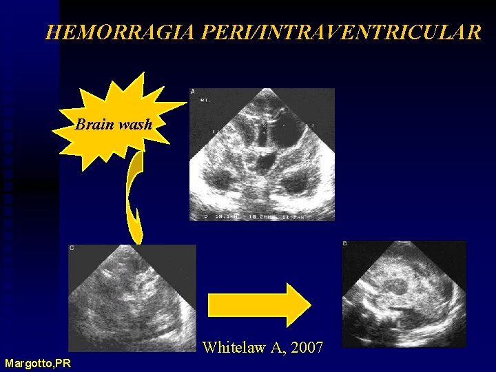 HEMORRAGIA PERI/INTRAVENTRICULAR Brain wash Whitelaw A, 2007 Margotto, PR 