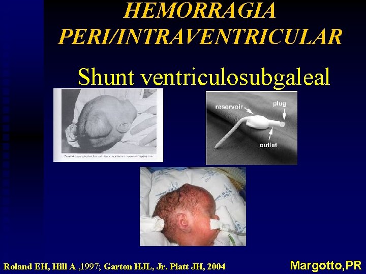 HEMORRAGIA PERI/INTRAVENTRICULAR Shunt ventriculosubgaleal Roland EH, Hill A , 1997; Garton HJL, Jr. Piatt