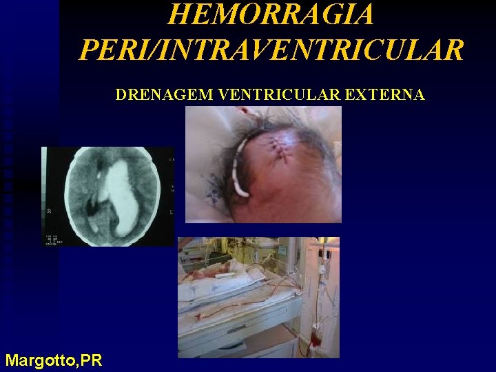 HEMORRAGIA PERI/INTRAVENTRICULAR DRENAGEM VENTRICULAR EXTERNA Margotto, PR 
