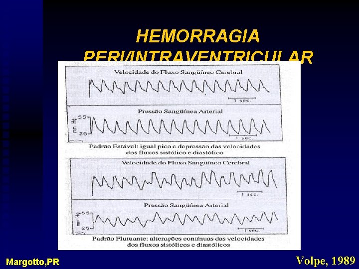 HEMORRAGIA PERI/INTRAVENTRICULAR Margotto, PR Volpe, 1989 