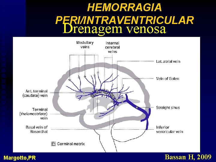 HEMORRAGIA PERI/INTRAVENTRICULAR Drenagem venosa Margotto, PR Bassan H, 2009 