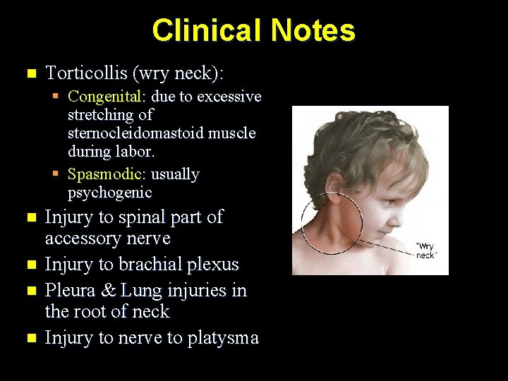 Clinical Notes n Torticollis (wry neck): § Congenital: due to excessive stretching of sternocleidomastoid