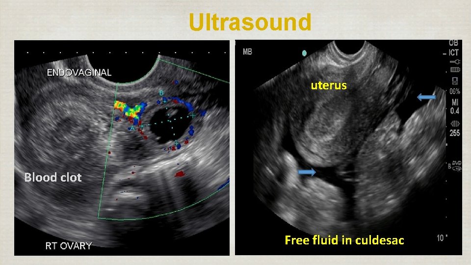 Ultrasound uterus Blood clot Free fluid in culdesac 