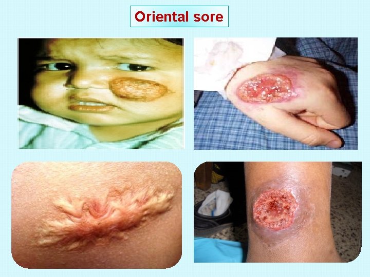 Oriental sore 