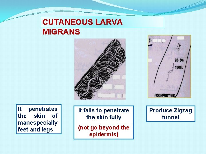 CUTANEOUS LARVA MIGRANS It penetrates the skin of man especially feet and legs It