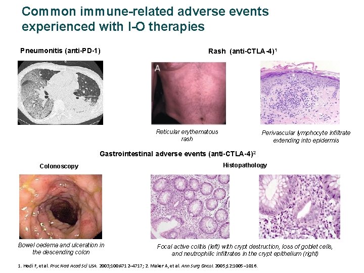 Common immune-related adverse events experienced with I-O therapies Pneumonitis (anti-PD-1) Rash (anti-CTLA-4)1 Reticular erythematous