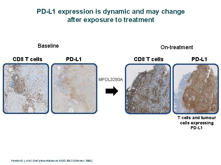 PD-L 1 expression is dynamic and may change after exposure to treatment Baseline CD