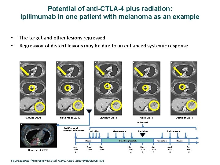 Potential of anti-CTLA-4 plus radiation: ipilimumab in one patient with melanoma as an example