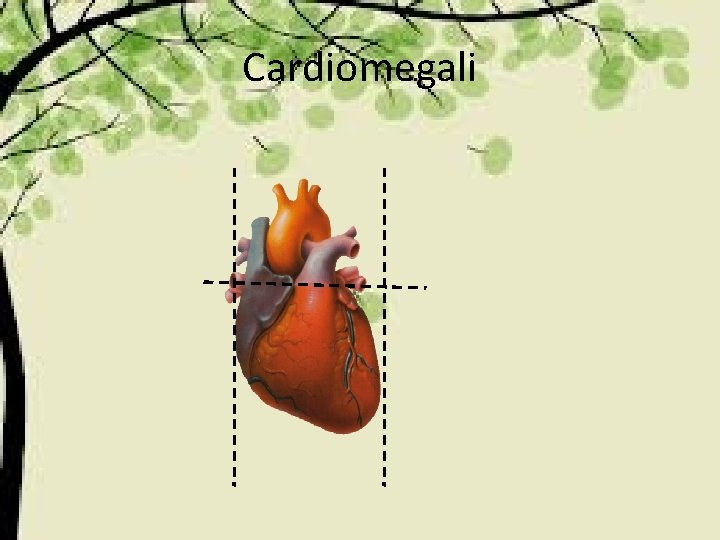 Cardiomegali 