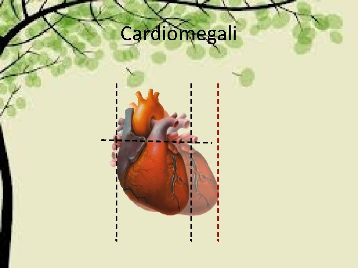 Cardiomegali 