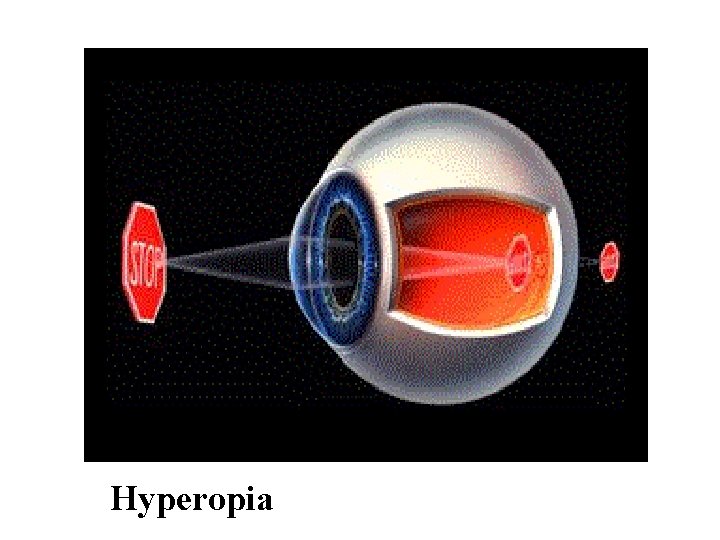 Hyperopia 