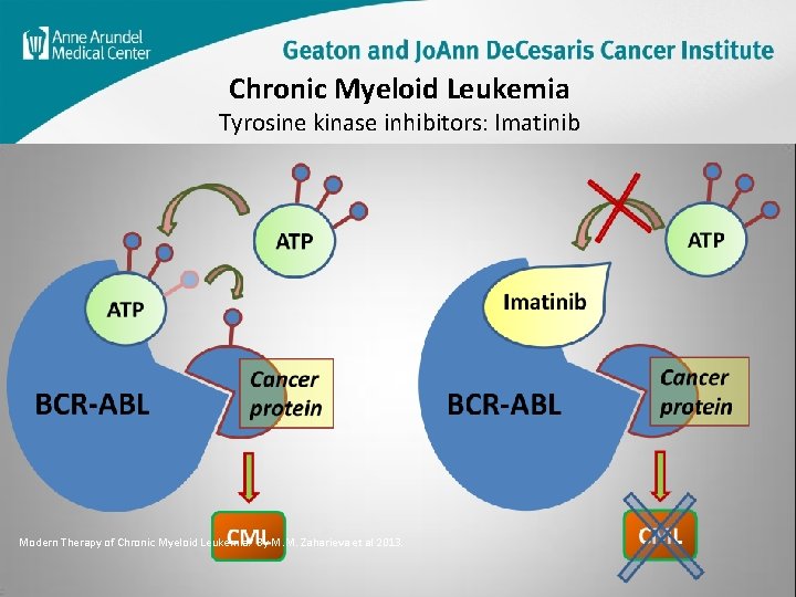 Chronic Myeloid Leukemia Tyrosine kinase inhibitors: Imatinib Modern Therapy of Chronic Myeloid Leukemia. By