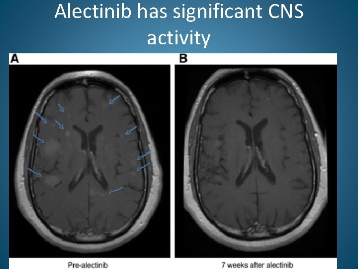 Alectinib has significant CNS activity 