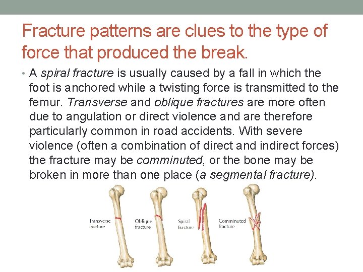 Fracture patterns are clues to the type of force that produced the break. •