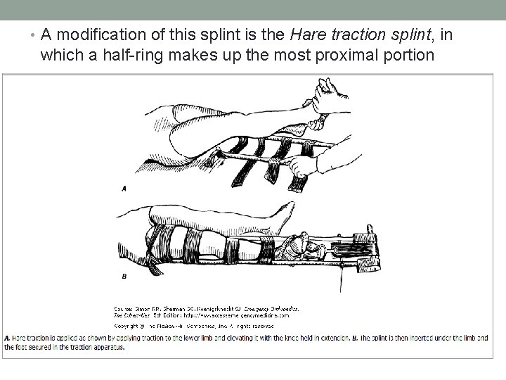  • A modification of this splint is the Hare traction splint, in which