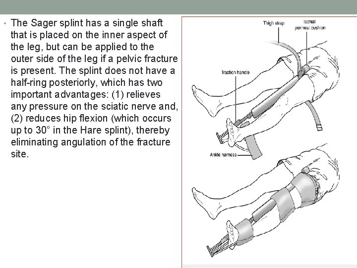  • The Sager splint has a single shaft that is placed on the