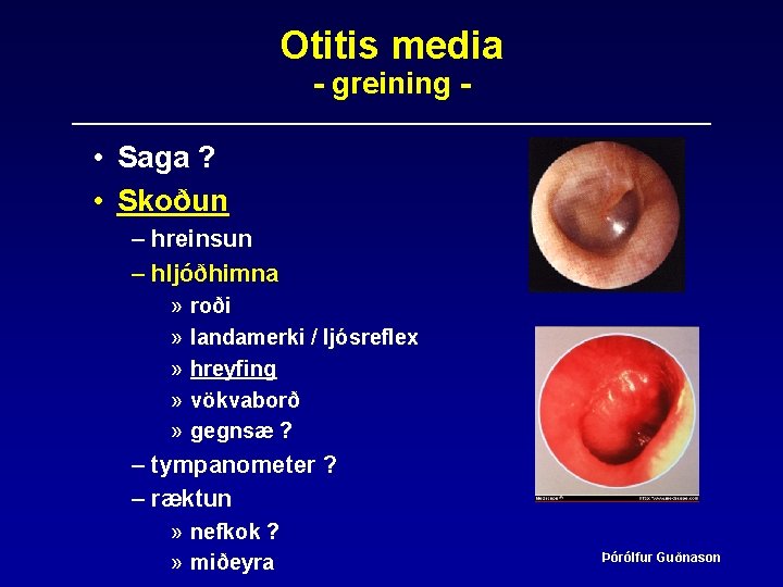 Otitis media - greining - • Saga ? • Skoðun – hreinsun – hljóðhimna