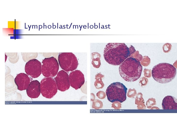 Lymphoblast/myeloblast 